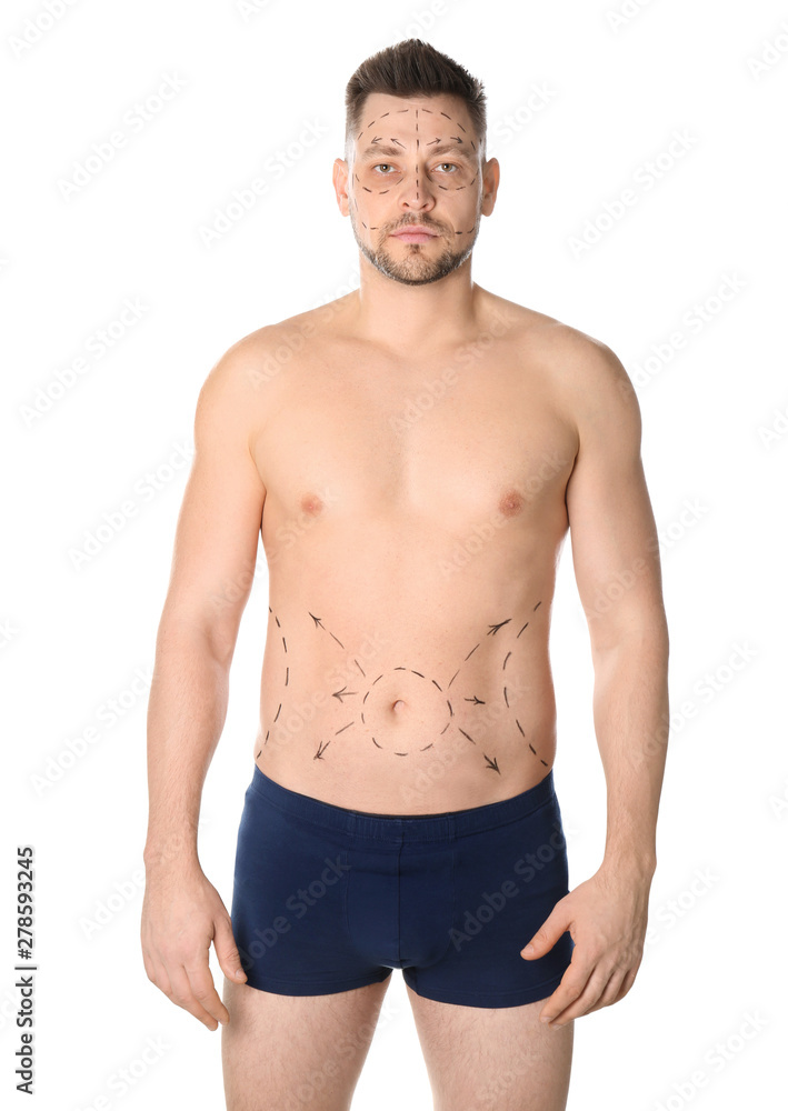 Man with marks on belly for cosmetic surgery operation against white background