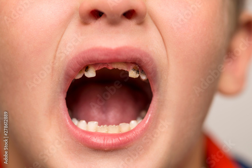 Kid patient open mouth showing cavities teeth decay. Close up of unhealthy baby teeth. Dental medicine and healthcare