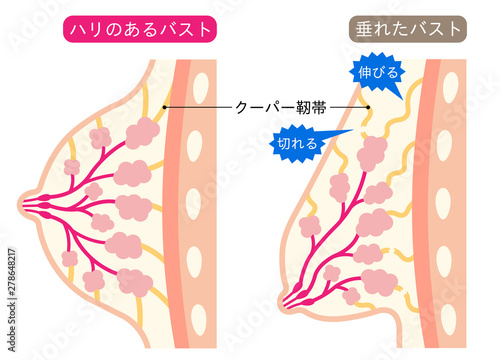きれいなバストと垂れたバスト　ビフォアアフター