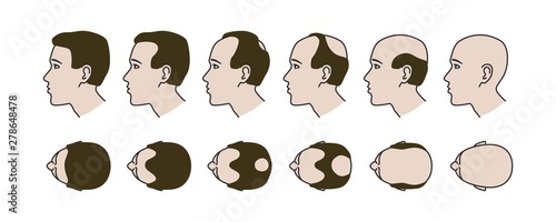 Stages of baldness, transplantation and hair extensions, treatment of baldness