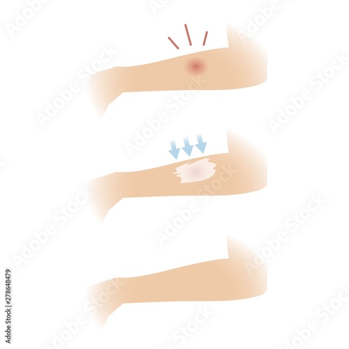 Red spot on the skin, insect bite, pimple, treatment, ointment or gel for itching and inflammation