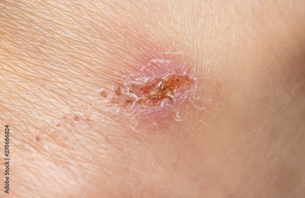Fototapeta premium Little wound on human skin