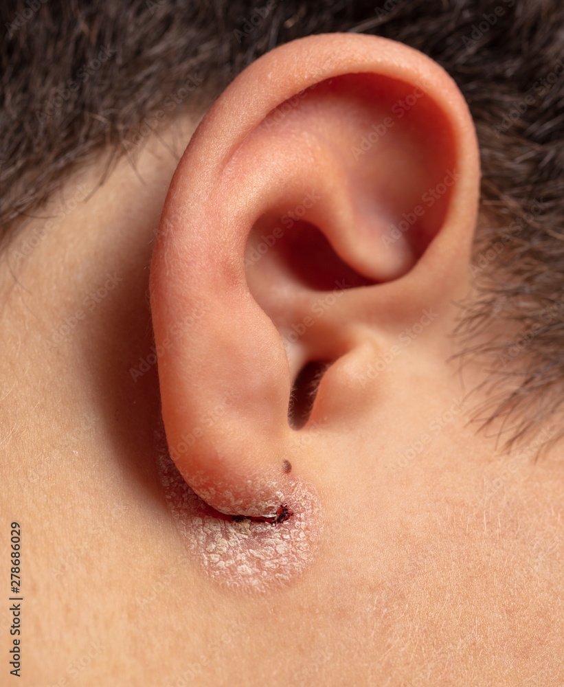 Inflamed wound in the boy's ear Inflamed wound in the boy's ear