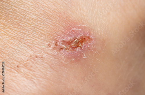 Little wound on human skin