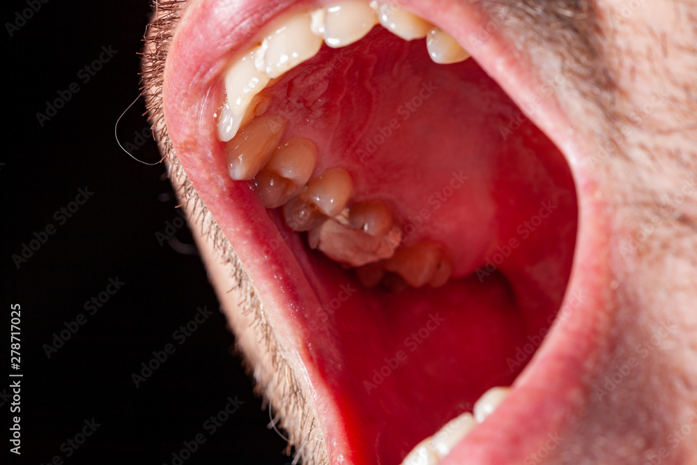 Obraz premium temporary filling of a tooth caries patient