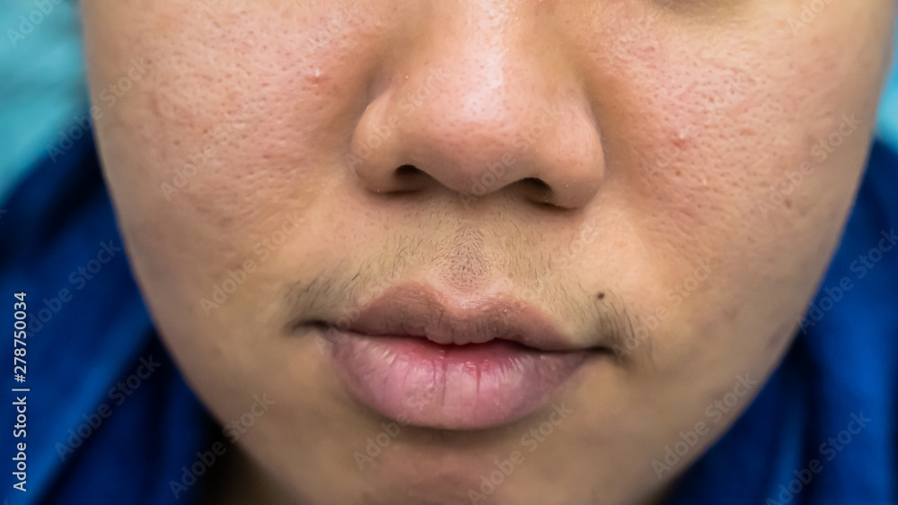 Obraz premium Facial acne is Asian women aged 25-30 and pores wrinkles are allergic to cosmetics.