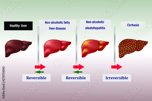 stage disease of the liver , arrows indicate reversible and irreversible stages