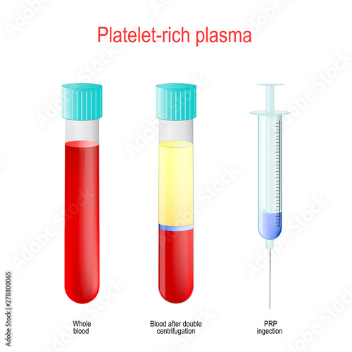 PRP. Two test tubes and syringe with blood and platelet-rich plasma.