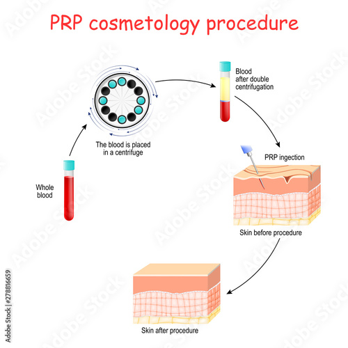 PRP cosmetology procedure. test tubes and syringe with blood and platelet-rich plasma