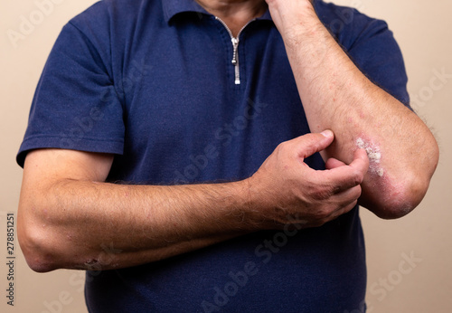 Photos Close up dermatitis on skin, ill allergic rash dermatitis eczema of patient , at