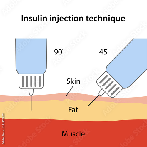 Insulin injection technique for diabetes depending on needle angle: 90 and 45 degrees. Anatomical vector illustration in flat style isolated over white background.