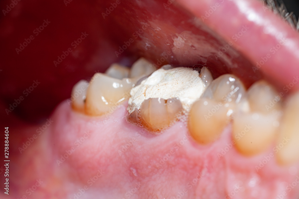 temporary filling of a tooth caries patient