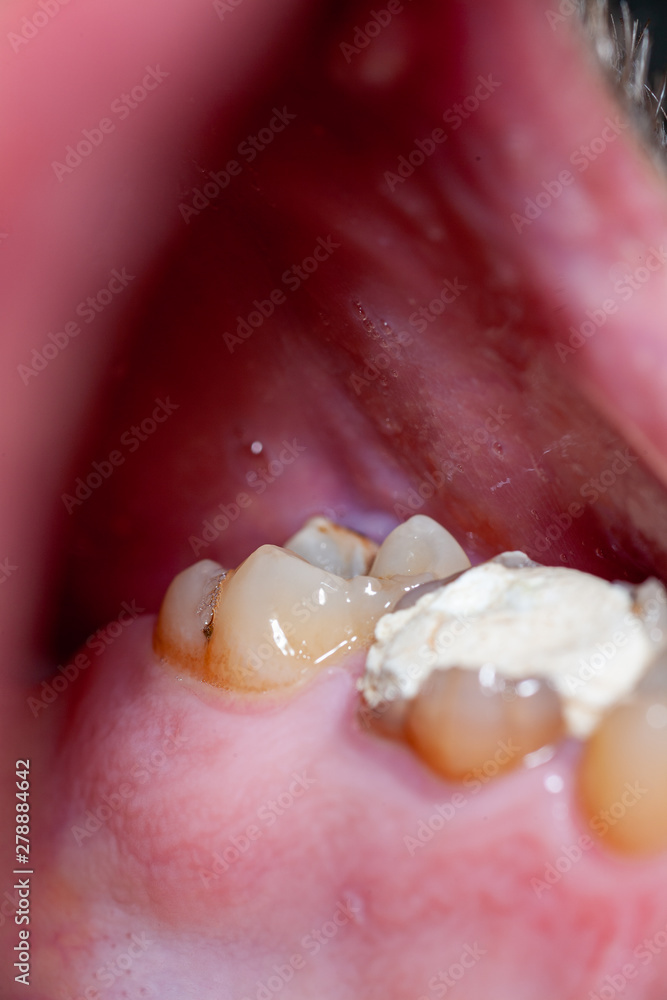 temporary filling of a tooth caries patient Stock Photo