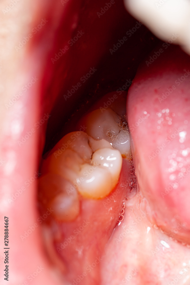 Obraz premium temporary filling of a tooth caries patient