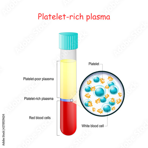 PRP. test tube with blood and platelet-rich plasma. Components of blood.