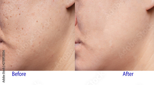 Picture of before and after treatment in beauty clinic of Woman's problematic skin , acne scars ,oily skin and pore, dark spots and blackhead and whitehead on the face.