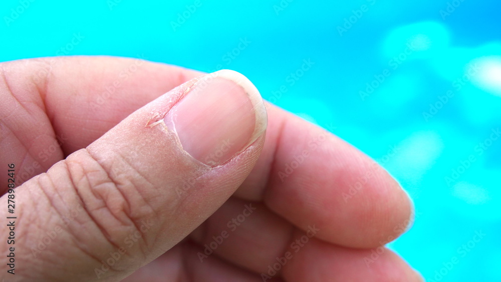 Badly torn cuticles on finger nails Badly torn cuticles on finger nails