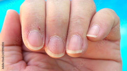 Quadro su tela Badly torn cuticles on finger nails