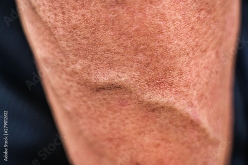 vein texture close up  high blood pressure   alcoholic line on body skin.