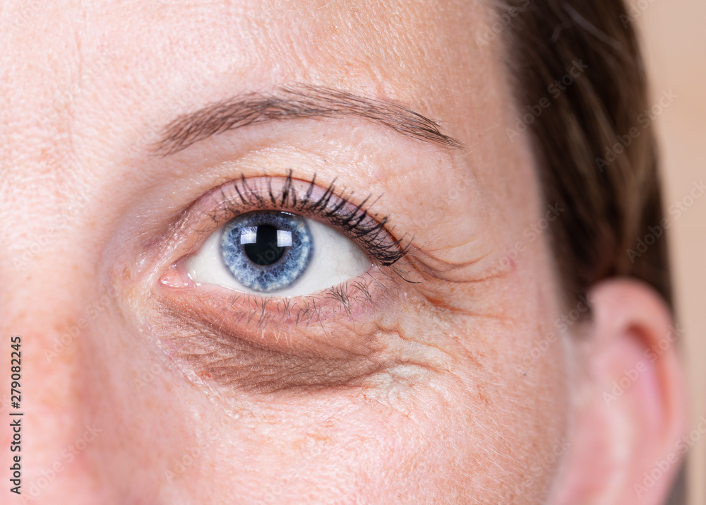 Fototapeta premium A close-up view on the blue eye of a forty something Caucasian lady with a swollen and dark bag beneath the eye. Fluid retention in delicate skin through aging and tiredness.