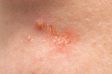 A closeup view on the Caucasian skin of a young woman. Small pustules are seen gathered together with yellow crusty and flaking skin. Symptomatic of herpes simplex virus.
