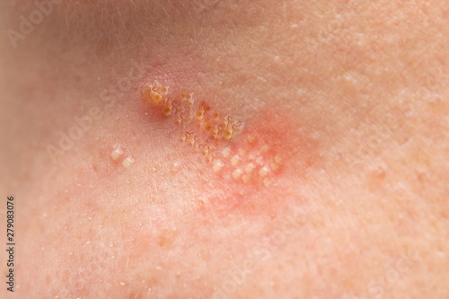 A closeup view on the Caucasian skin of a young woman. Small pustules are seen gathered together with yellow crusty and flaking skin. Symptomatic of herpes simplex virus. photo