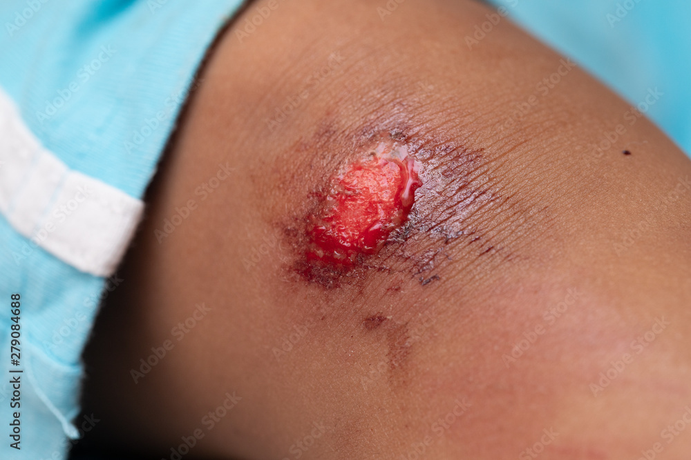 An extreme close up view on the bloody grazed leg of an innocent young child. Injury sustained from playing outdoors. An extreme close up view on the bloody grazed leg of an innocent young child. Injury sustained from playing outdoors.