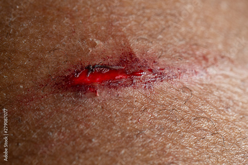 Obraz na plátne A macro view of a deep and bloody cut on human skin