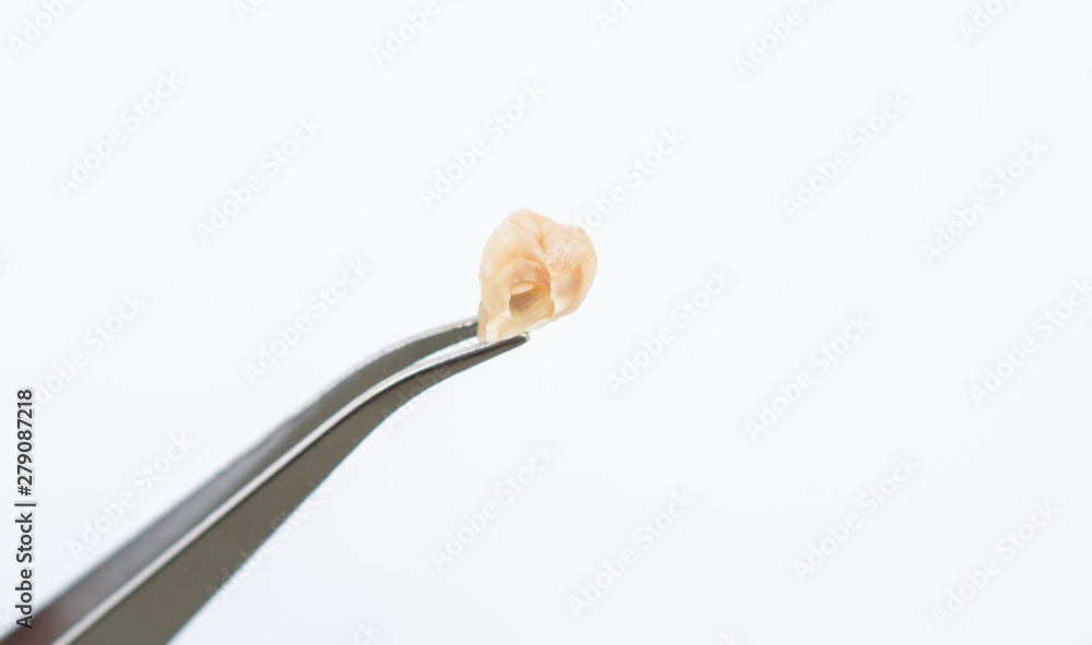 Tweezer holding old removed crack wisdom tooth in heart shape mouth isolated on white background, dentist found unhealthy damaged cavities teeth cause pain toothache at dentistry hospital Tweezer holding old removed crack wisdom tooth in heart shape mouth isolated on white background, dentist found unhealthy damaged cavities teeth cause pain toothache at dentistry hospital
