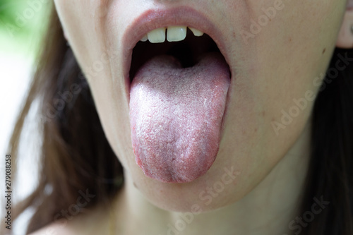 A closeup view on the tongue sticking out of the mouth of a Caucasian girl in her 30s. A white coating is seen, symptomatic of oral thrush, a common yeast infection in adults.