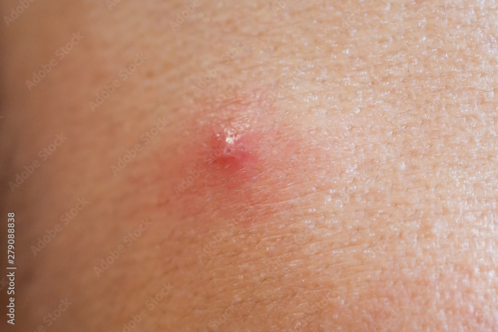 Fototapeta premium Inflammatory acne with red spot on face closeup