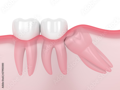 3d render of jaw with wisdom mesial impaction