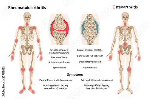 MobileThe difference between rheumatoid arthritis and osteoarthritis. On the body, arthritic sites are marked. Images of joints affected by rheumatoid arthritis and osteoarthritis. Vector illustration photo