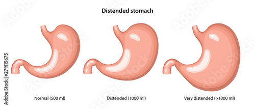 Distended stomach. Stages of distension of the stomach. Flat vector illustration isolated over white background. photo