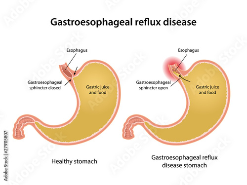 Gastroesophageal reflux disease stomach with main parts labeled. Anatomical vector illustration in flat style with healthy and sick stomach isolated over white background.