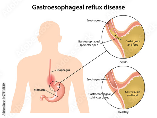 Gastroesophageal reflux disease stomach with main parts labeled. Medical vector illustration with the shape of sick human body, fragments of healthy and sick stomach isolated on white background