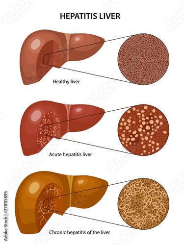 Hepatitis liver. Histology of the healthy liver and Hepatitis liver with corresponding labels. Anatomical vector illustration in flat style isolated over white background. photo
