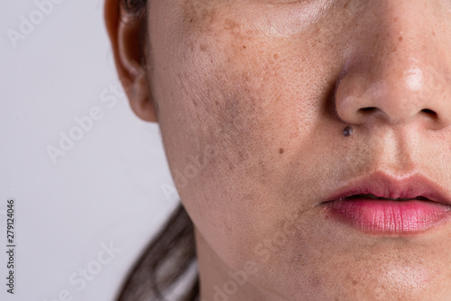 Woman with problematic skin and acne scars. Problem skincare and health concept. Wrinkles melasma Dark spots freckles dry skin and pigmentation on face asian woman.