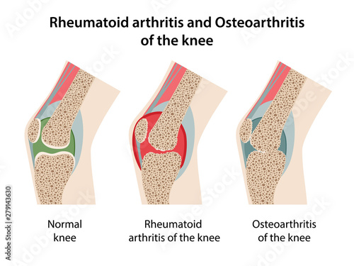 Rheumatoid arthritis and osteoarthritis of the knee. Image of healthy knee and diseased knees with main parts labeled. Vector illustration in flat style isolated over white background