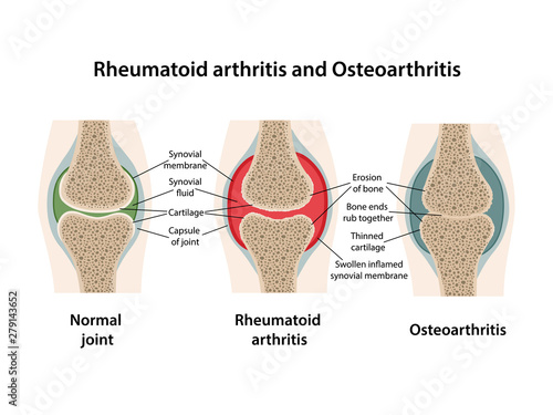 Rheumatoid arthritis and osteoarthritis of the joint. Images of healthy joint and diseased joints with main parts labeled. Vector illustration in flat style isolated over white background