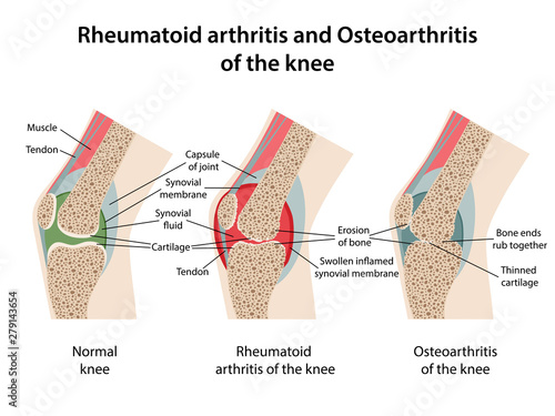 Rheumatoid arthritis and osteoarthritis of the knee. Image of healthy knee and diseased knees with main parts labeled. Vector illustration in flat style isolated over white background