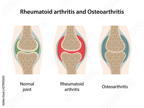 Rheumatoid arthritis and osteoarthritis of the joint. Images of healthy joint and diseased joints with main parts labeled. Vector illustration in flat style isolated over white background