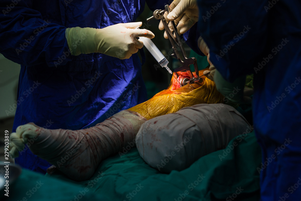 Team of doctor working at operating room in hospital. Surgeon perform total knee replacement surgery. Incision was made on patient 's knee in the case of osteoarthritis.Medical and orthopedic concept.