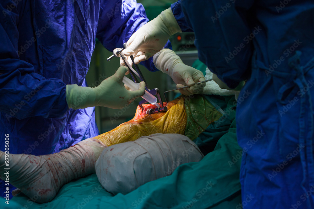 Team of doctor working at operating room in hospital. Surgeon perform total knee replacement surgery. Incision was made on patient 's knee in the case of osteoarthritis.Medical and orthopedic concept. Team of doctor working at operating room in hospital. Surgeon perform total knee replacement surgery. Incision was made on patient 's knee in the case of osteoarthritis.Medical and orthopedic concept.
