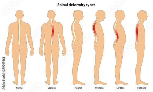Spinal deformity types. Anterior view and lateral view of human body. Anatomical vector illustration in flat style isolated over white background.