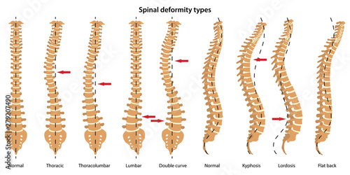 Spinal deformity types. Anterior view and lateral view of spinal. Anatomical vector illustration in flat style isolated over white background.