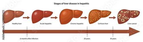 Stages of liver disease in hepatitis with description corresponding steps: healthy, acute, chronic hepatitis, cirrhosis and cancer liver. Vector illustration in flat style over white background
