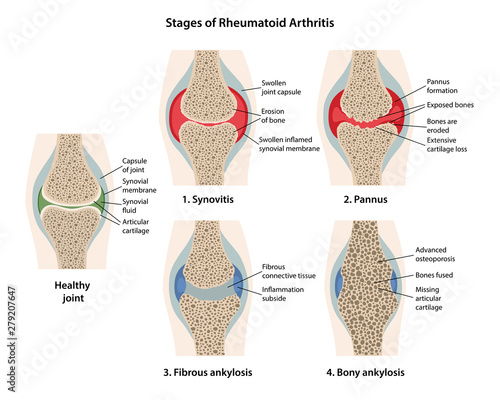 Rheumatoid arthritis stages of the joint with main parts labeled. Images of healthy joint and diseased joints with main parts labeled, isolated on white background. Vector illustration