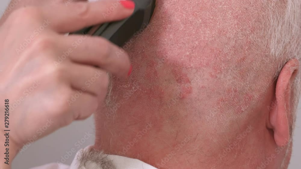 Man with skin diseases problems on head.Concept of eczema,psoriasis