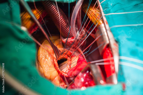 Tableau sur toile Mitral valve orifice in surgeon view
